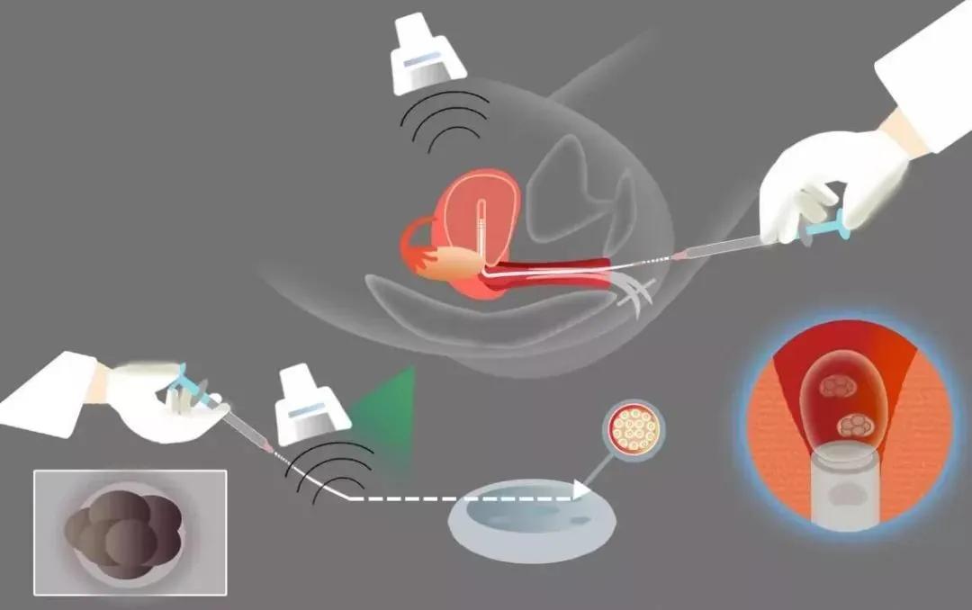 试管移植冻胚周期有几种方案,试管婴儿移植冻胚的最佳时间