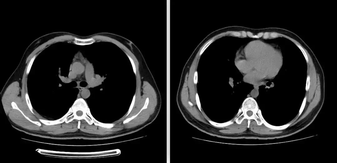 青年男性肺炎过后一直咳嗽怎么办,潜伏结核感染咳嗽咳痰