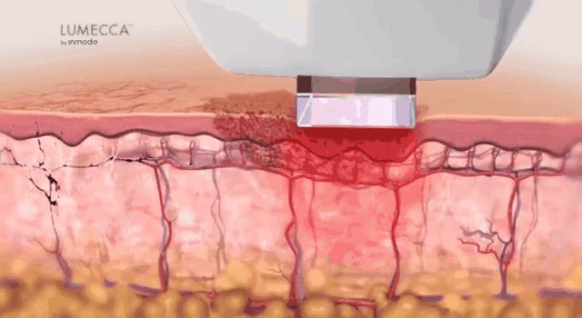 医美皮肤科医生介绍,医美小知识光子嫩肤