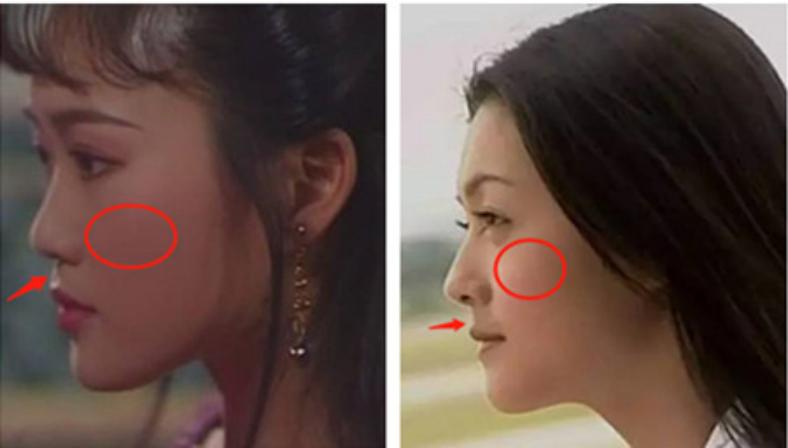 脸颊凹陷医美怎么改善,十全九美