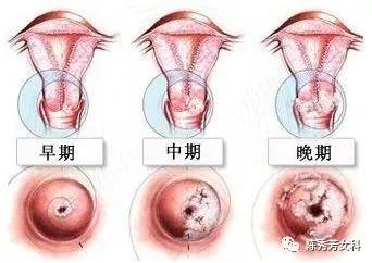 王熙凤血崩是怎么回事,王熙凤的血山崩原因