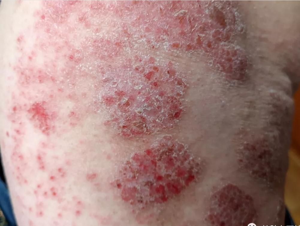 精神紧张焦虑湿疹皮炎就复发,湿疹皮炎总是复发