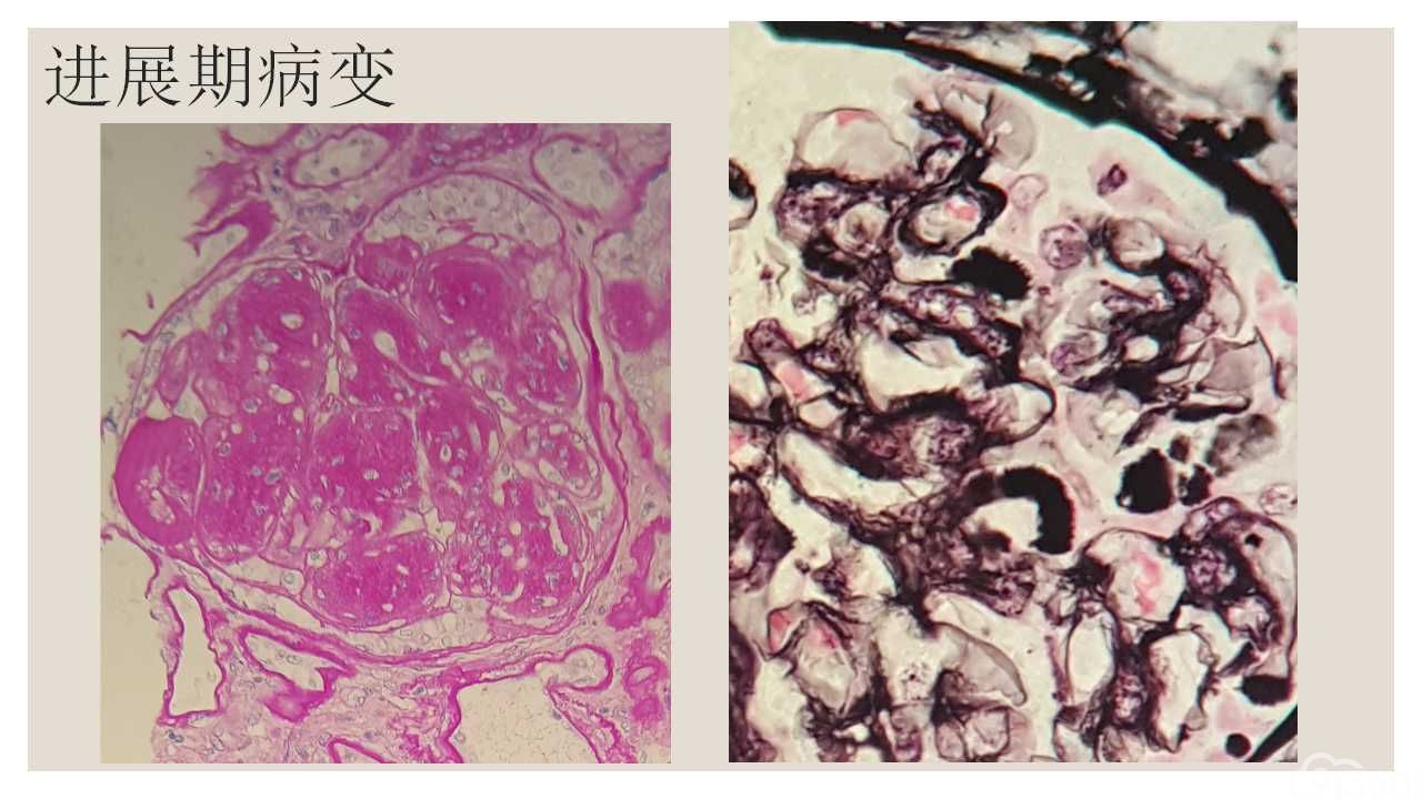 什么是肾穿刺,什么是肾穿刺检查