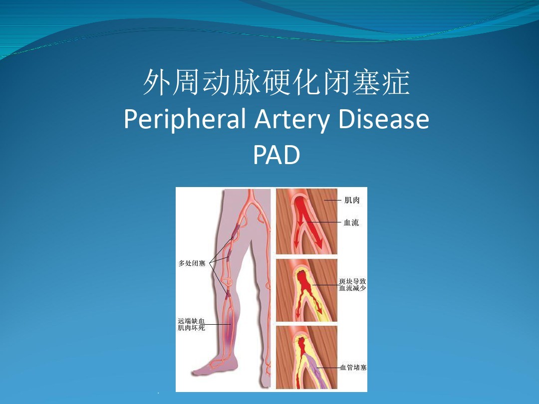 下肢动脉硬化闭塞中医什么科,老人下肢动脉硬化闭塞截肢