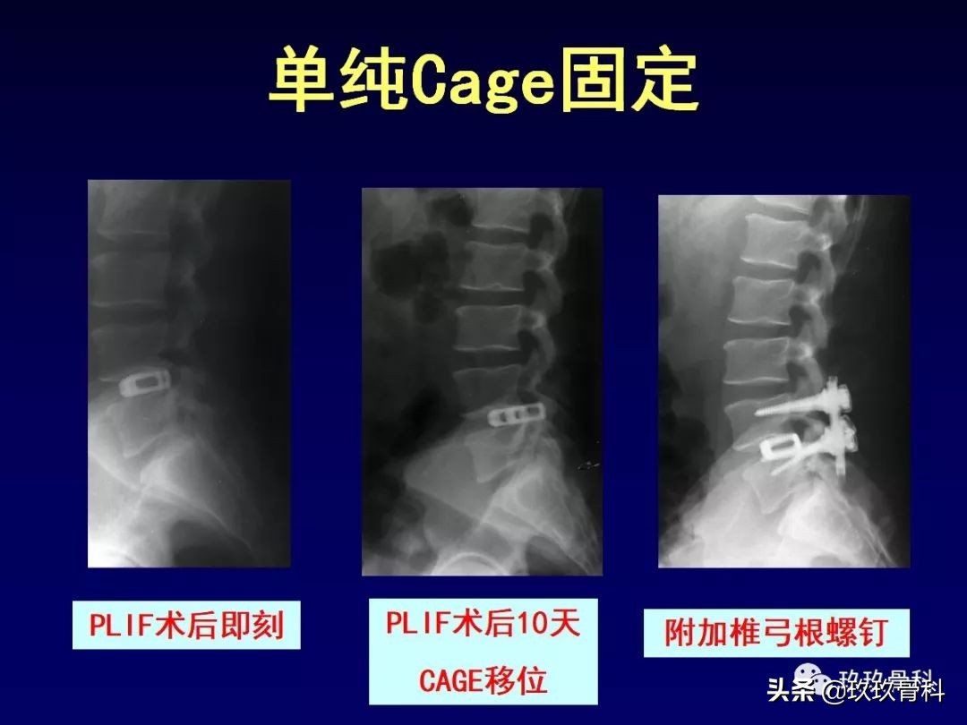 腰椎不稳最坏的结果,腰椎不稳的最佳治疗方法
