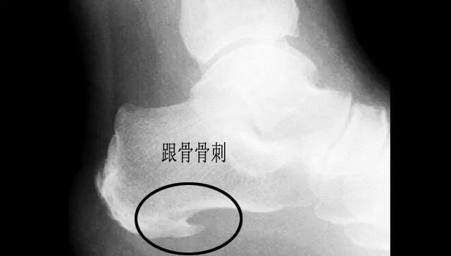 产后足跟痛是什么原因引起的,足跟痛是什么原因用什么贴