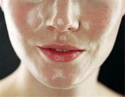 螨虫痘可以用洗面奶清洁吗,去螨虫去痘痘用什么洗面奶