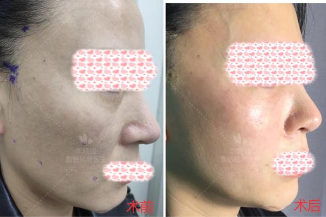 凹陷脸怎么整形,面部凹陷显老怎么整