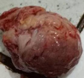 不开刀的子宫肌瘤消融术,不动手术做子宫肌瘤叫什么仪器