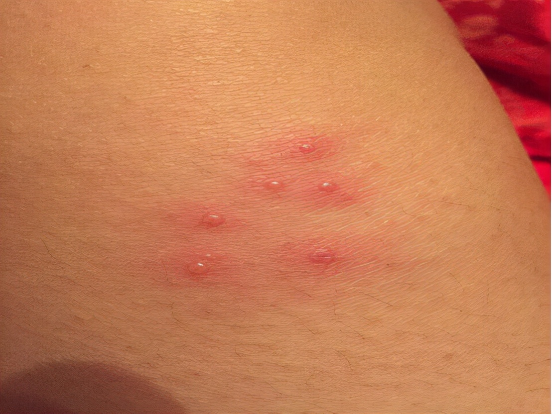 被隐翅虫毒液沾到涂什么药膏,被隐翅虫咬伤特效药