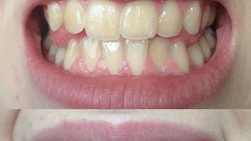 早晚刷牙了牙齿还是臭怎么回事,天天刷牙牙齿很黄很臭学会这一招