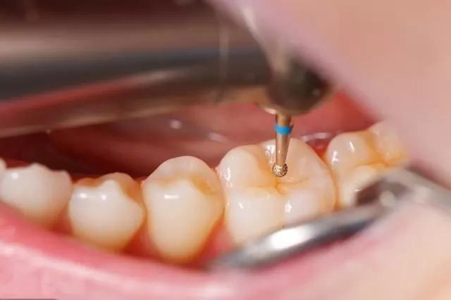 牙黄最有效变白方法,牙黄变白的正确方法学生党