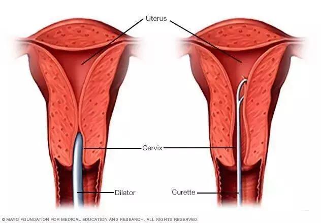 女子流产4次真相令人唏嘘,女孩堕胎14次