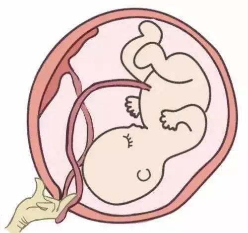 糟了!胎儿脐带掉出来了!