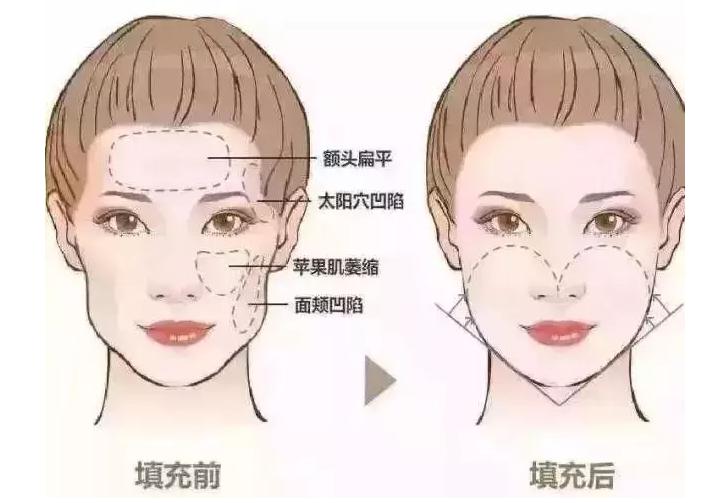 科普|光子嫩肤全攻略，做了光子后禁忌事项有哪些？