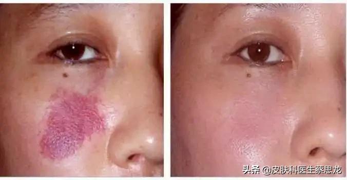 揭秘光子嫩肤的过程,一文看懂光学深度解读