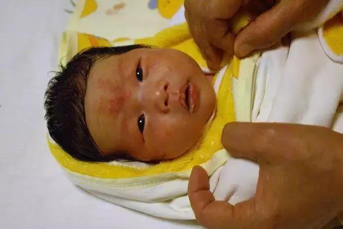 湿疹反反复复如何治疗不用激素药,孕妈妈得了湿疹之后应当如何治疗