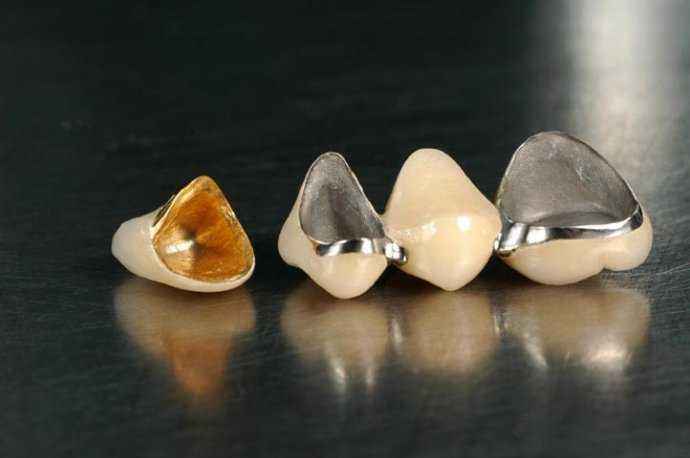 烤瓷牙崩了一块修复方法,烤瓷牙崩瓷了怎么修复