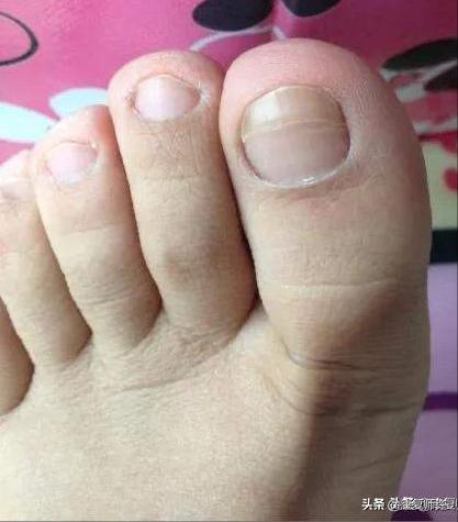 产后腹直肌分离的解决方法,产后腹直肌分离怎么处理