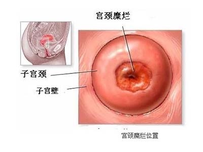 宫颈糜烂的5大谣传,宫颈糜烂和宫颈癌有必然联系吗