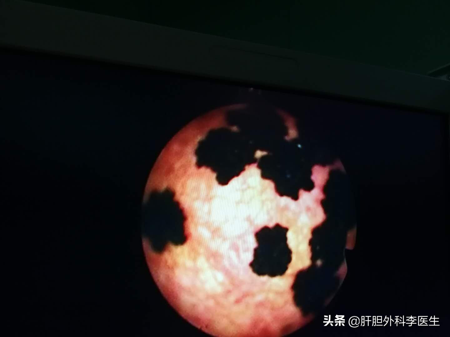 胆囊结石切除后胆管还会结石吗,胆囊结石合并胆息肉怎么办