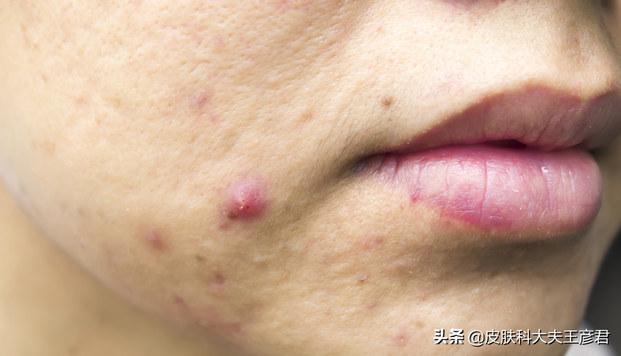 闭口脓包型大痘痘是什么原因,如何治疗脸上的暗疮痘痘图片