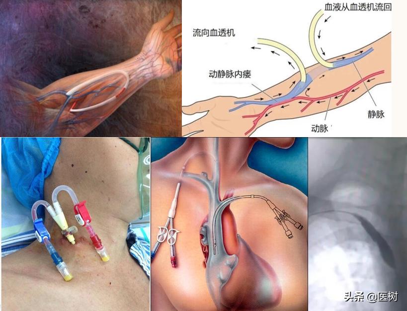 血液透析技术理论与应用,血液透析新技术新进展