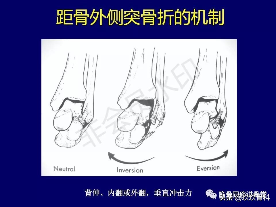 距骨骨折的治疗原则,距骨骨折如何调理