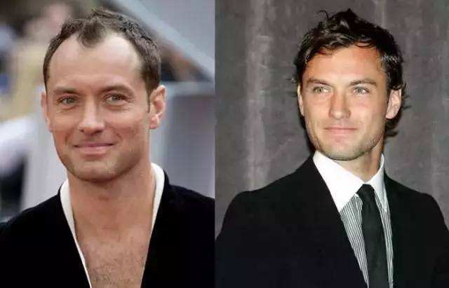 陈奕迅秃顶头发稀疏,陈奕迅同款发际线怎么补救