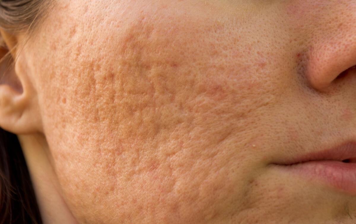 不同痘坑凹洞擦什么药膏,不同痘坑怎么修复