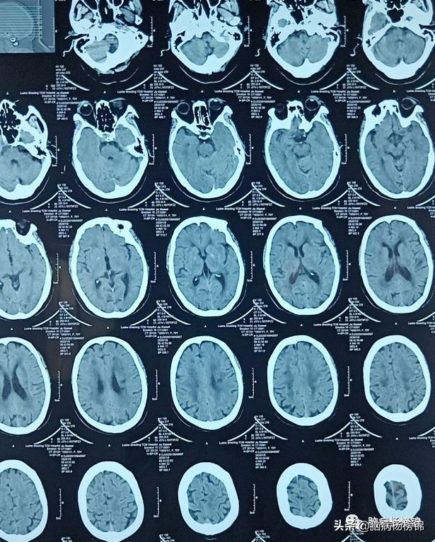 脑出血和脑梗塞同时出现已经昏迷,急性脑梗塞和急性脑出血同时出现