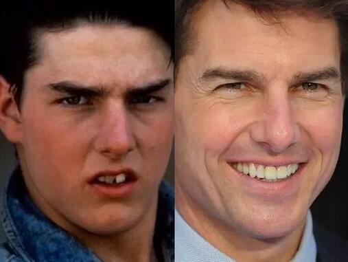 吴宣仪烤瓷牙怎么做,吴宣仪的整牙前