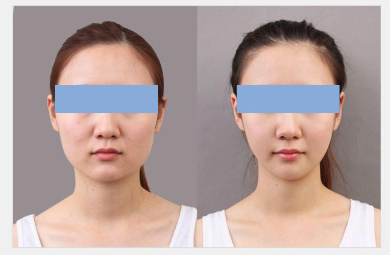 所有人都有咬肌肥大,脸颊咬肌肥大怎么办