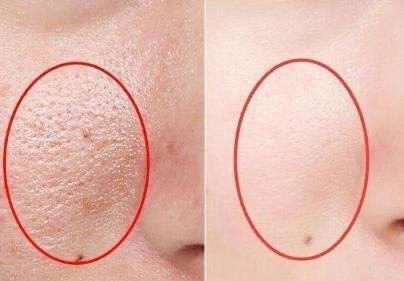 脸上毛孔粗大为什么不可逆,鼻子上的毛孔粗大不可逆