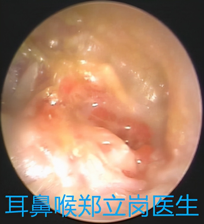 胆脂瘤中耳炎手术是微创还是开刀,胆脂瘤中耳炎手术从哪里开刀