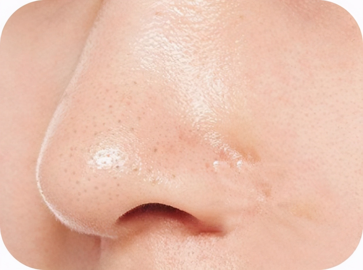 40岁以后毛孔明显了,40岁女人脸上毛孔大怎么办