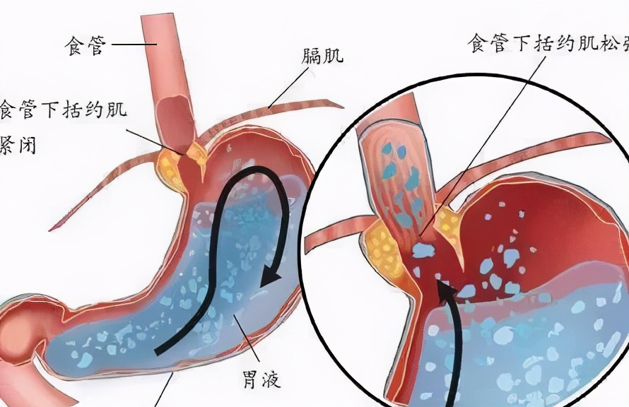 反酸吃花生米有用吗,反酸烧心吃花生米真的管用吗