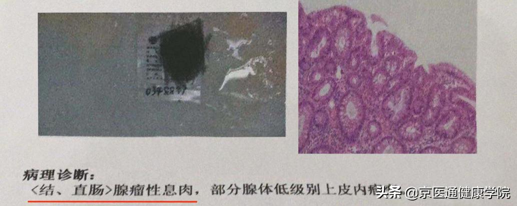 升结肠0.4息肉是癌的可能性是多少,胃体多发息肉0.2-0.4是癌吗