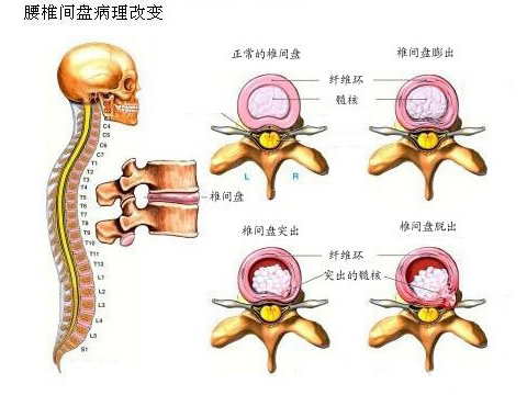 腰椎膨出和突出还有脱出图片,腰椎间盘突出脱出膨出区别
