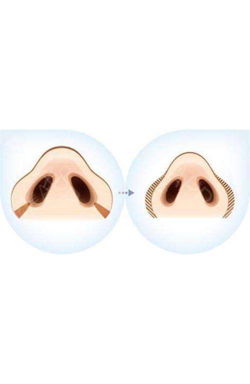 单纯缩鼻翼缩小鼻孔要怎么做,单纯的鼻翼大缩鼻翼有效果吗