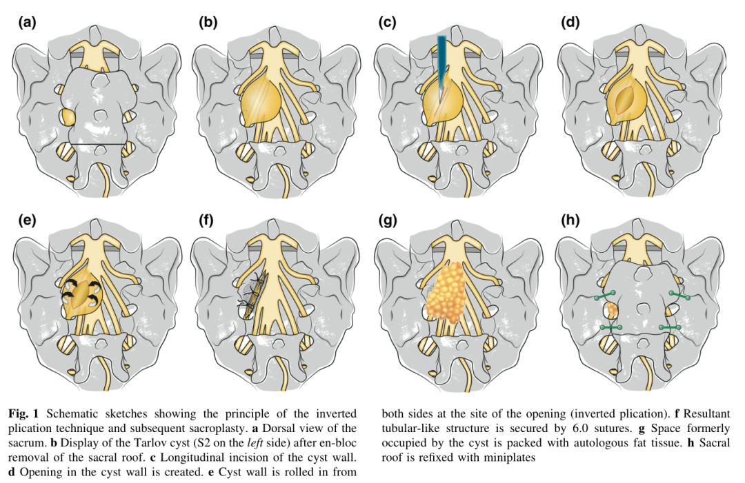 骶管囊肿介入治疗最新进展,骶管囊肿可以鉴定出来吗