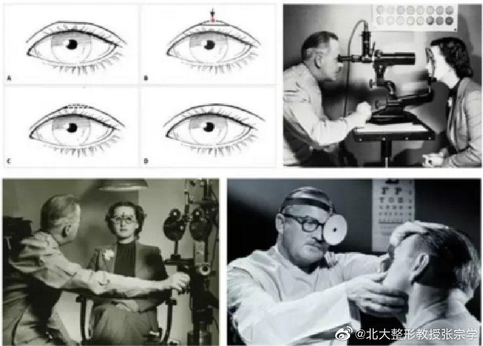 那些绝美的双眼皮手术,2022年最流行的双眼皮技术是哪个