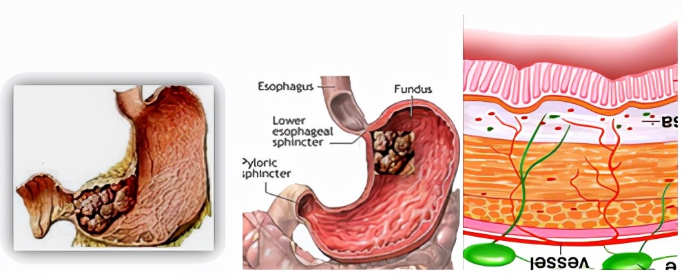 我不是药神,我不是财迷!若患胃癌,这些靶向药你有能力负担吗?