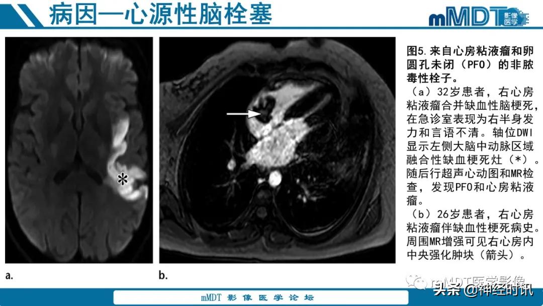 缺血性脑卒中护理课件,缺血性脑卒中讲课ppt