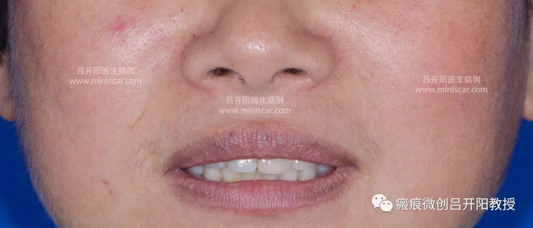 强脉冲激光治疗脸部视频,点阵激光嫩肤