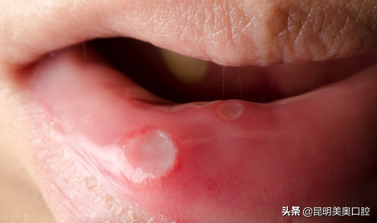 一个人经常口腔溃疡是怎么回事,一个人口腔溃疡是什么原因