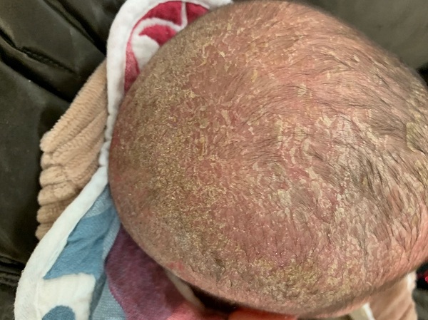 宝宝夏天湿疹严重怎么办,宝宝夏天湿疹怎么消除