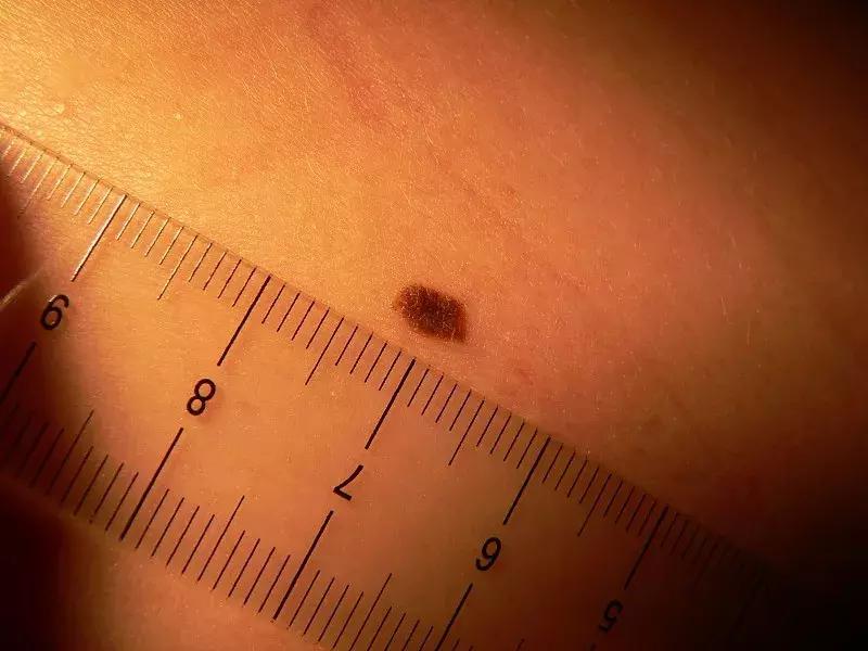 医生如何判断痣切干净了没,医生如何判断痣与黑色素瘤