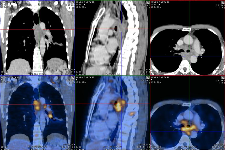 腰痛与肺癌有关吗,腰痛的厉害是得了肾癌吗