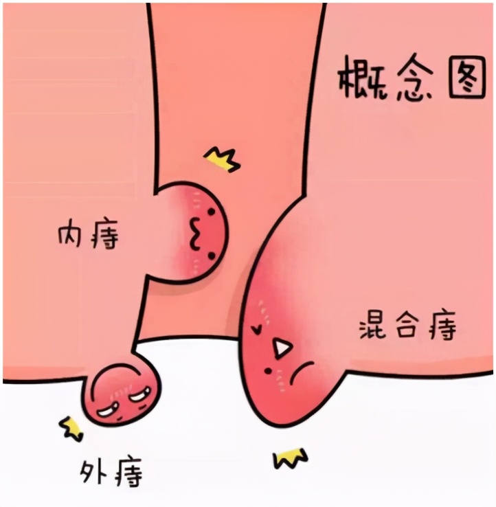 什么是痔疮？胡适有话说